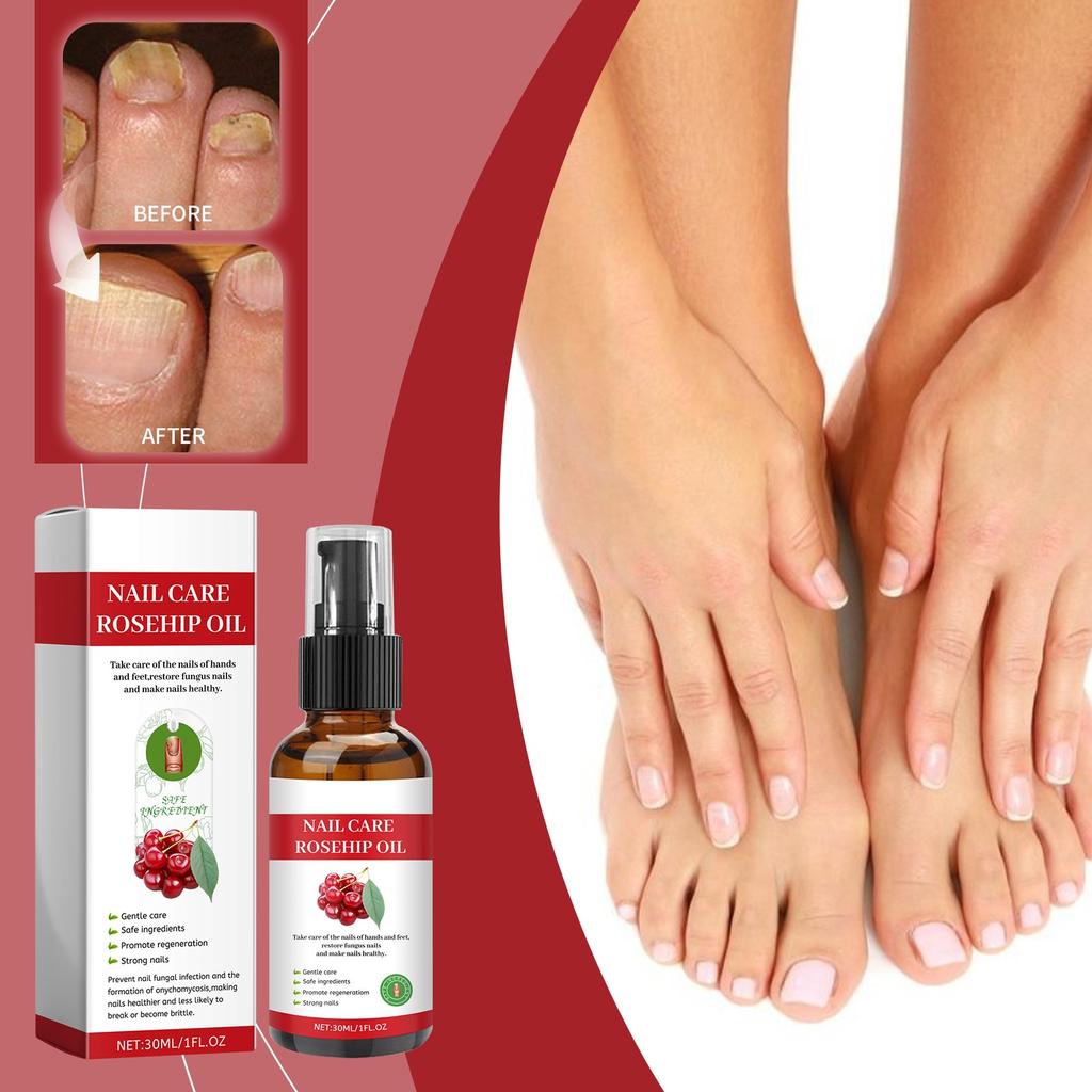 Nail FungusTreatment Toenail And FingerAnti-Fungal For Discolored Or Damaged Nails.30ml
