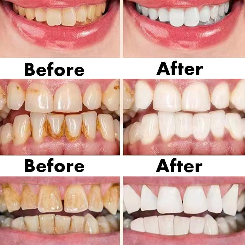 Ручка для чистки зубов, отбеливание зубов, удаление меланина, инструменты для чистки зубов, ремонт зубов, удаление налета, красота, здоровье