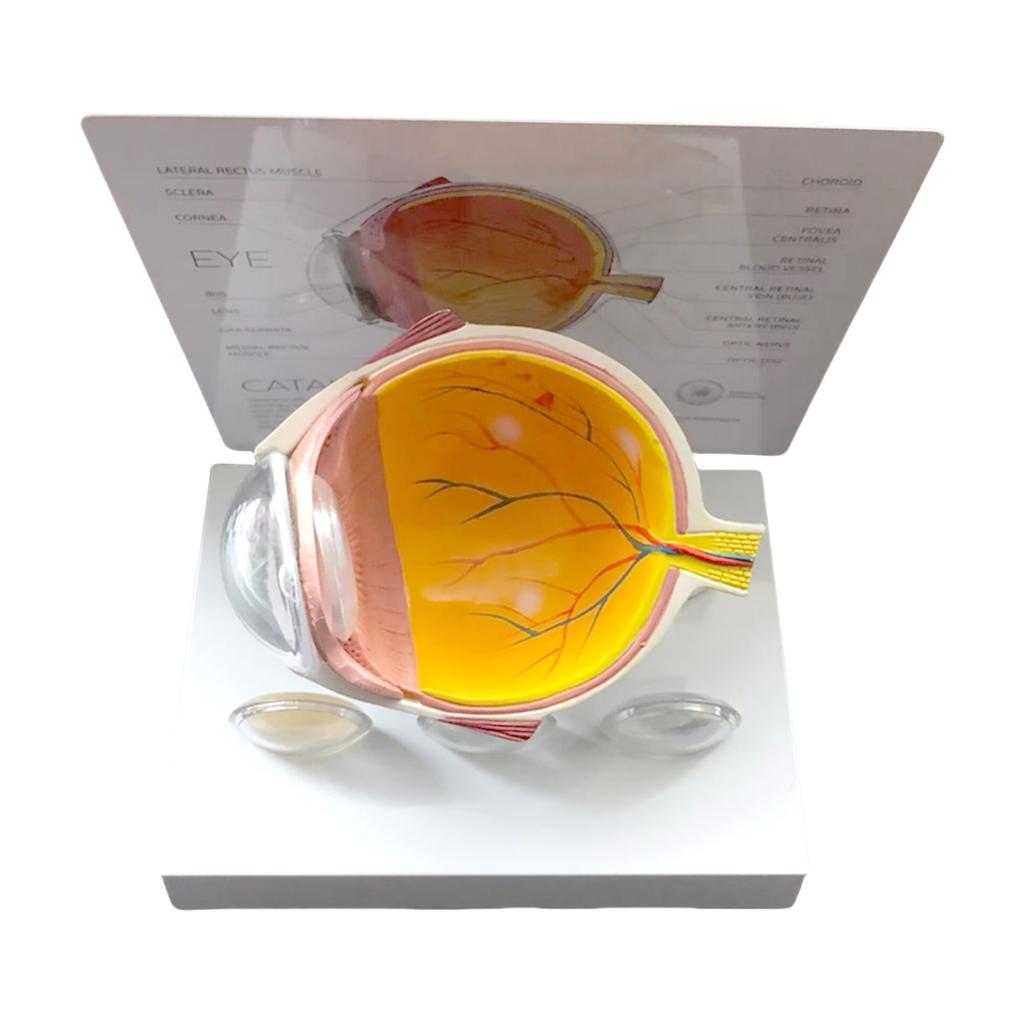 Модель анатомии человеческого глаза Анатомическая патологическая модель глазного яблока Обучающее пособие Реалистичная патологическая модель анатомии глазного яблока