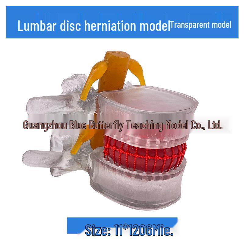 Подлинная модель протрузии поясничного отдела позвоночника и патологии позвонка