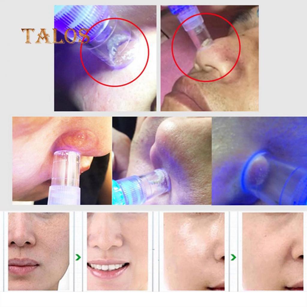 Машинка для вакуумного пилинга кожи