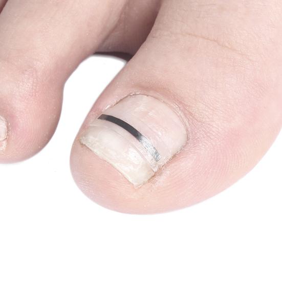 Набор для коррекции вросшего ногтя из титанового сплава для исправления искривленного ногтя Инструмент для лечения вросшего ногтя Выпрямитель для ногтей на пальцах ног