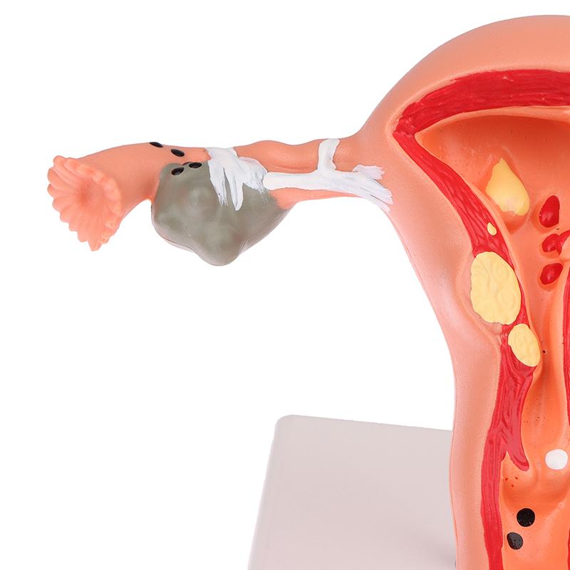 1 шт., медицинский реквизит, модель патологической матки, яичников, анатомическая модель, инструмент для изучения поперечного сечения анатомии
