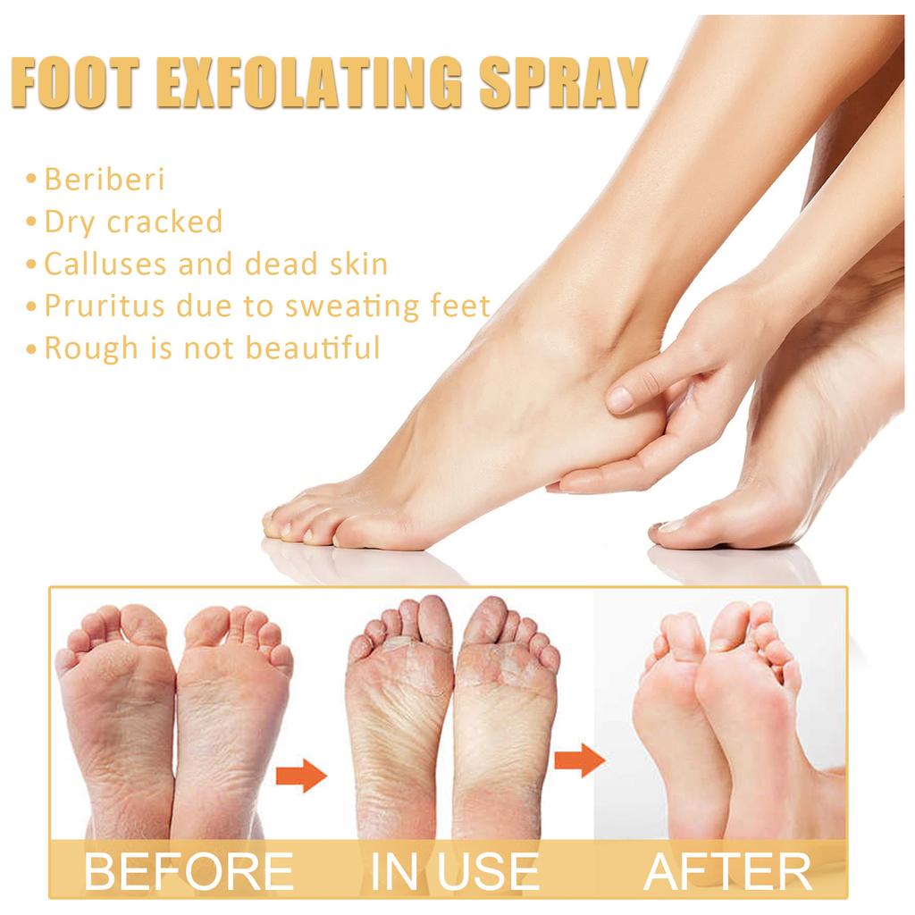 EELHOE Foot Peeling Spray Natural Orange Essence Pedicure Hands Dead Skin Exfoliator Mask Whiten Baby Foot Care Tool
