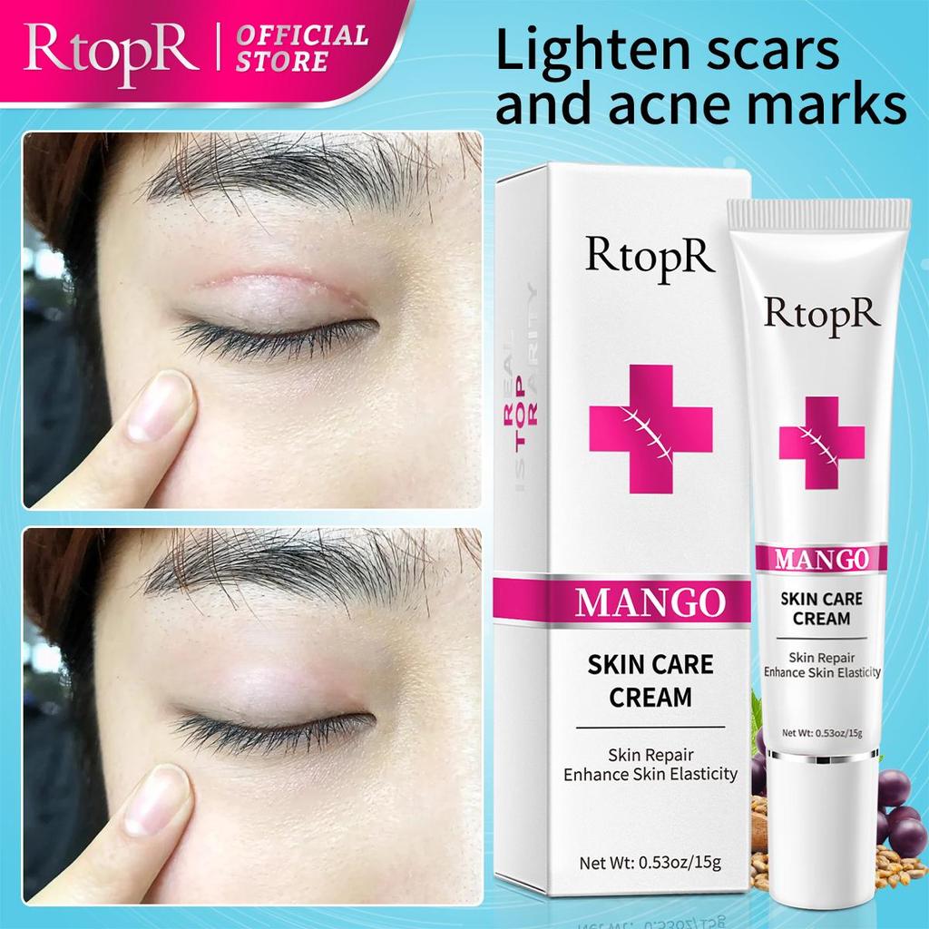 RtopR Acne Removal Cream - Spot Removal & Skin Repair 15g