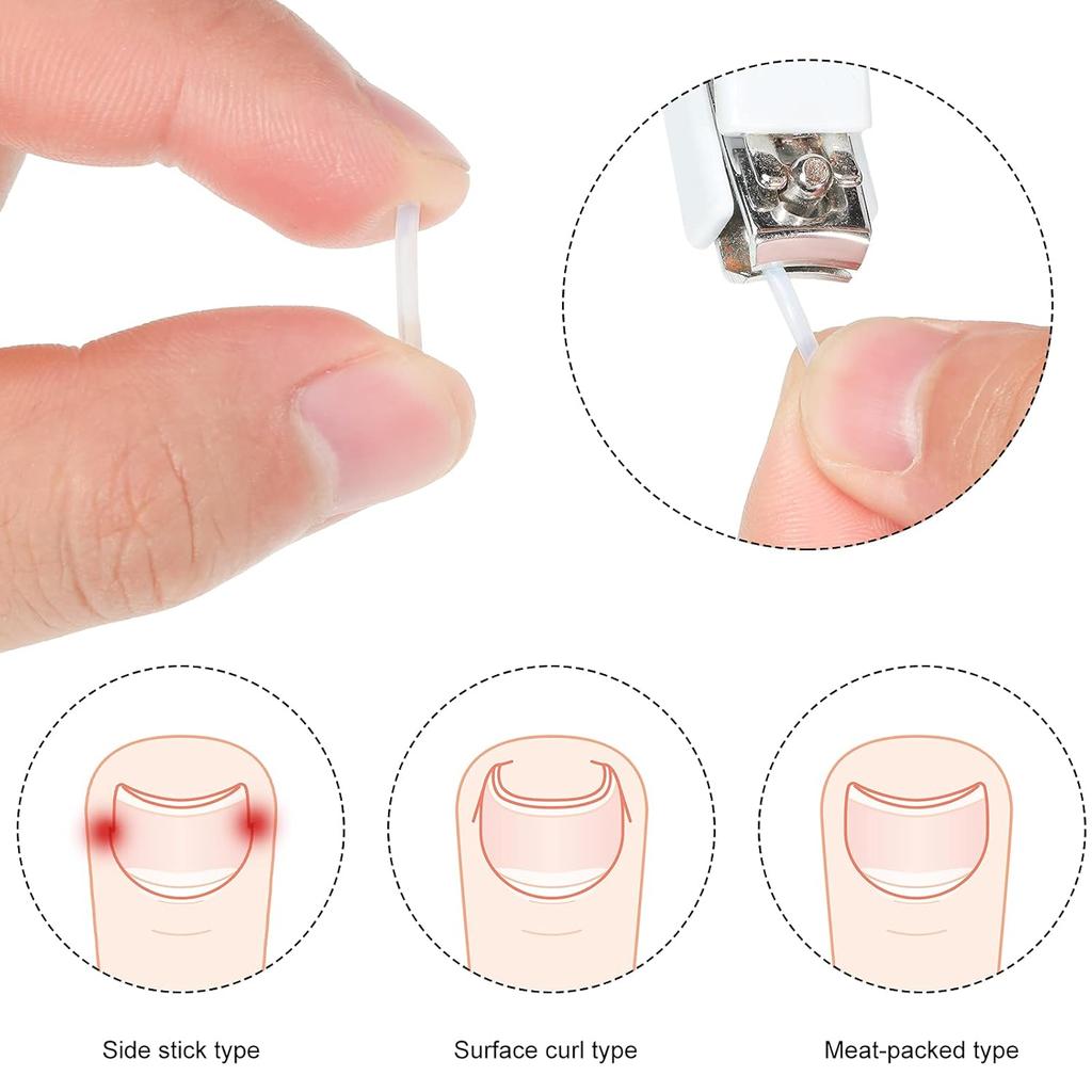 Корректор вросшего ногтя Полоски Ноготь Коррекция Ногтя Корректор Зажим Для Коррекции Выпрямление Ногтя Восстанавливающий Пластырь Корректор Изогнутого Ногтя 2 Стили