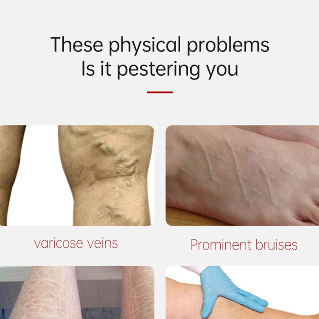 Паста для облегчения варикозного расширения вен Улучшение кровообращения Варикозное расширение вен Для усталых тяжелых ног Быстрое облегчение Новое