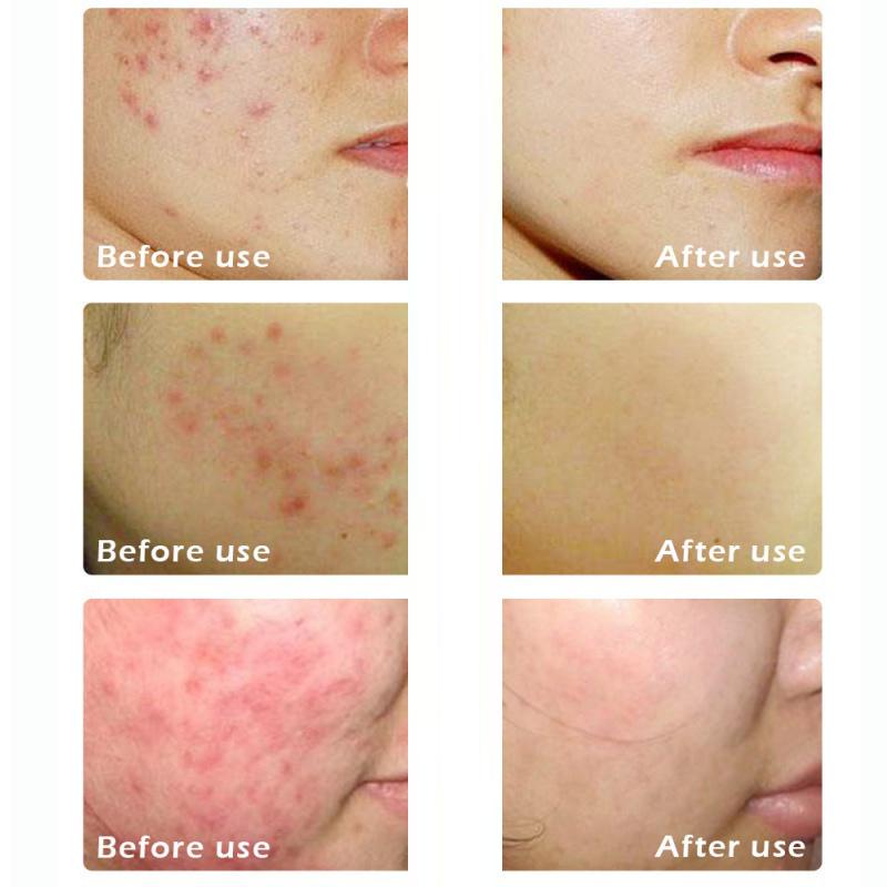 Крем для лечения прыщей, увлажняющее масло для контроля, сужение пор, удаление следов, средство для удаления прыщей