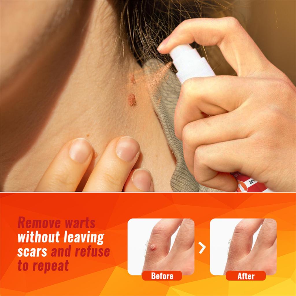 Спрей для удаления кожи 30 мл, Быстродействующий, Длительное облегчение, Растительный спрей для удаления кожи