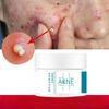 Acne Removing Cream Regulates Acne Muscles, Removes Acne, Desalinates Acne Marks, Moisturizes and Repairs Face Cream Acne Removing Cream