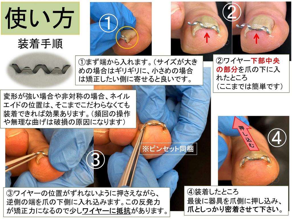 Nail Aid 16 мм Коррекция вросшего ногтя Сделай сам Проволочный зажим