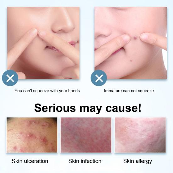 Yousheng 7 шт. набор инструментов для удаления черных точек из нержавеющей стали набор для удаления угрей профессиональный инструмент для удаления черных точек и белых угрей для лица