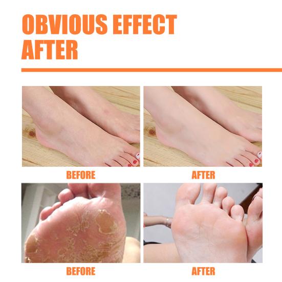 30 мл/100 мл EELHOE спрей для пилинга ног, глубоко питательный, быстро впитывающийся, аксессуар для ног, отшелушивающий спрей для омертвевшей кожи