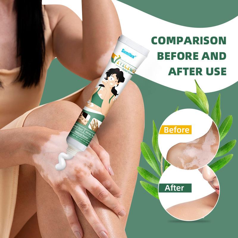 Мощный крем для лечения витилиго и изменения цвета кожи