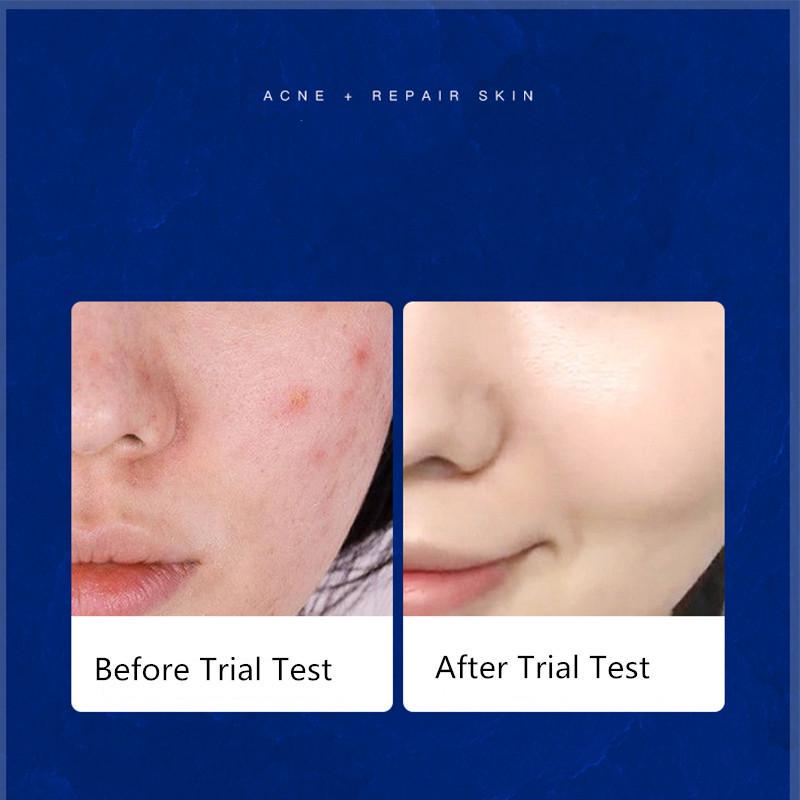 SENANA Крем от прыщей, увлажняющий, контроль жирности, исчезновение следов прыщей, легкий, не раздражающий.