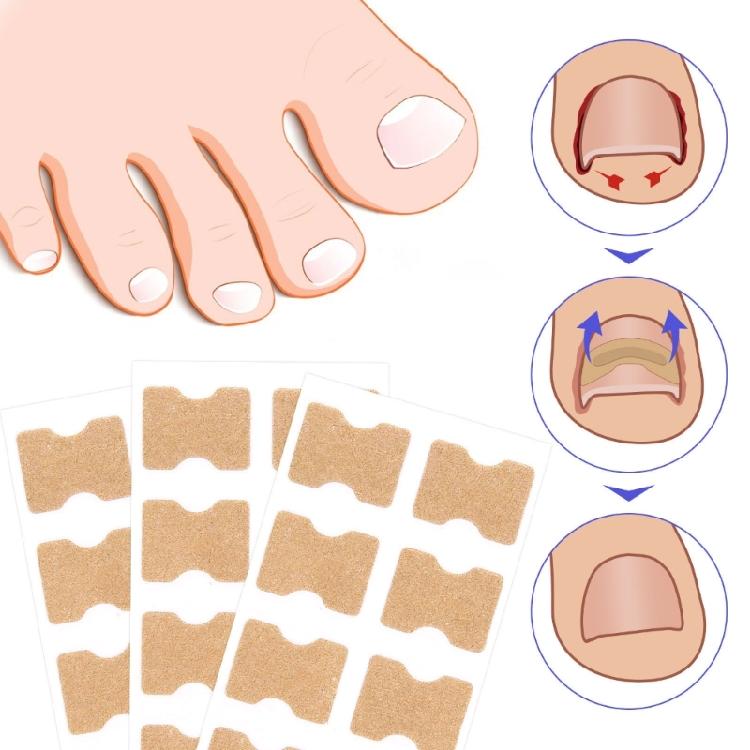 100pcs Paronychia Toenail Corrector Ingrown Patch Foot Care Nail Repair Patch