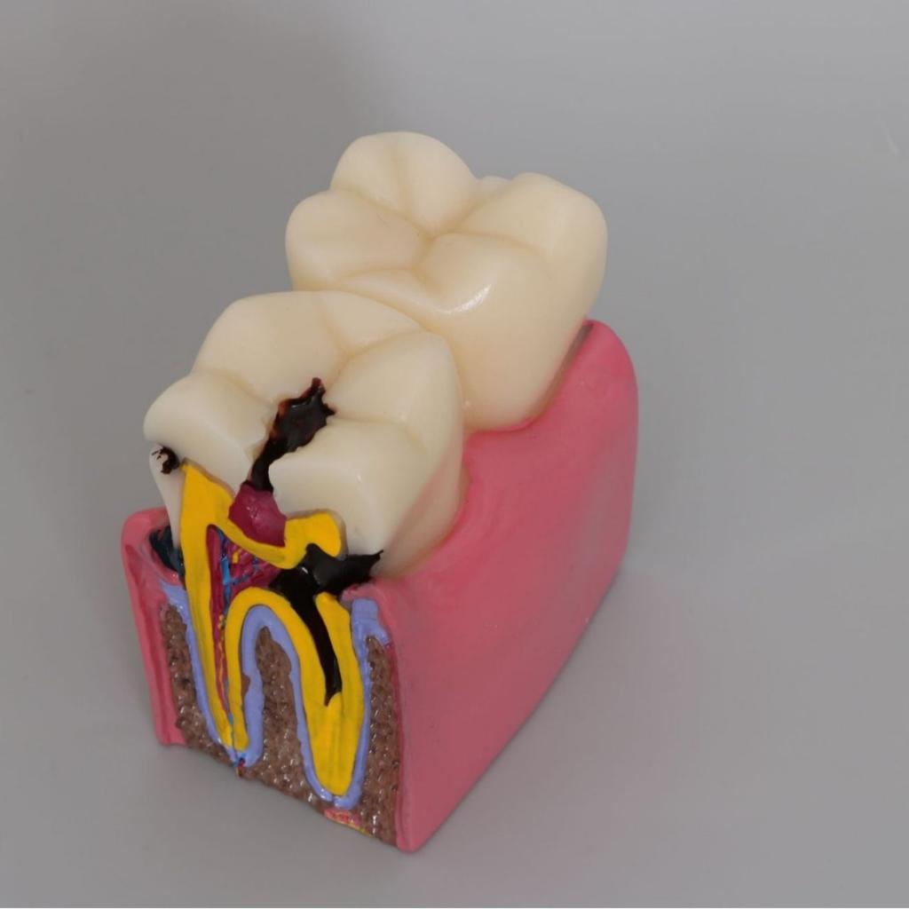 6 раз Модель кариеса зубов Болезнь зубов Стоматологическая модель для демонстрации зубов Модель обучения стоматолога Стоматологическая лаборатория Исследования полости рта