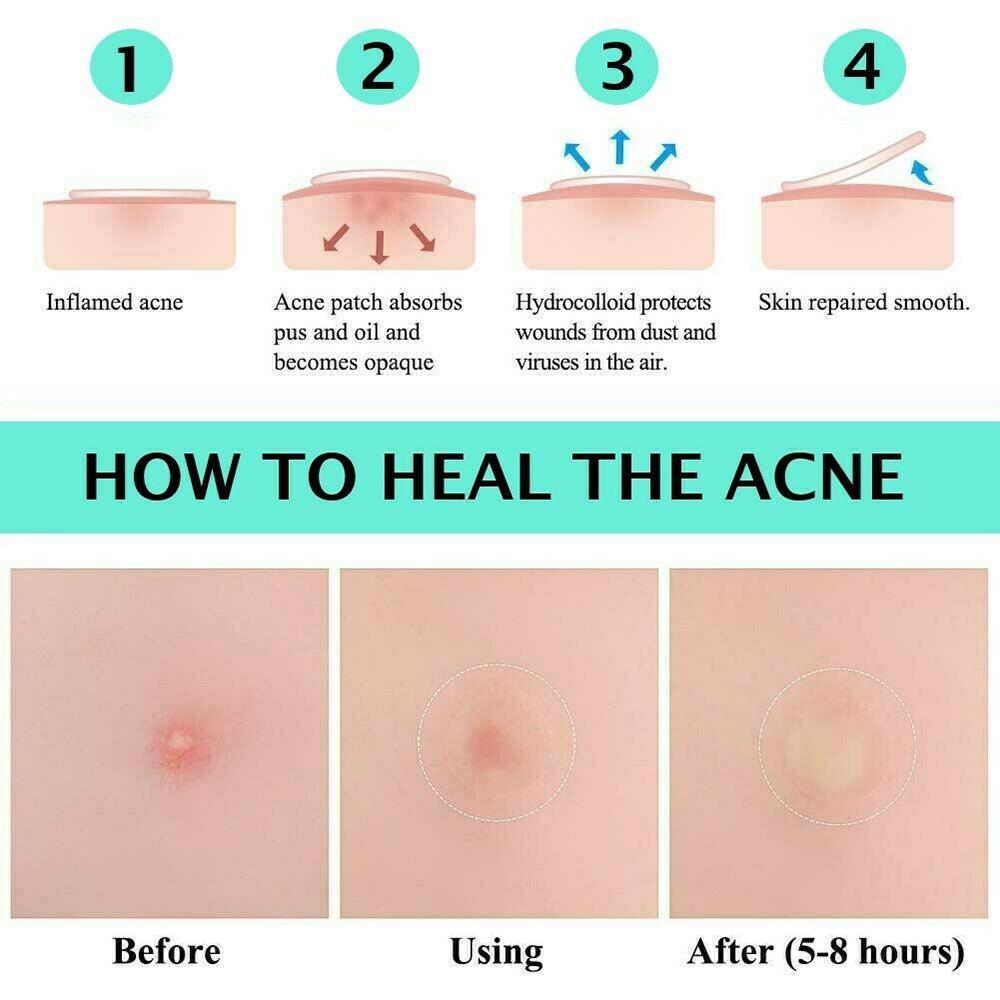 72 шт., лечебные пластыри от прыщей и прыщей, невидимые наклейки для ухода за пятнами на лице