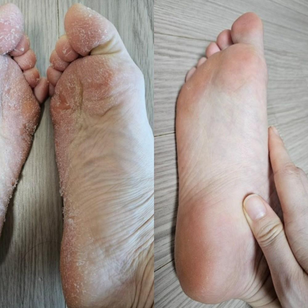 Perorin Don Quijote набор для удаления мозолей на ногах с ароматом розы, 2 упаковки, 1 упаковка