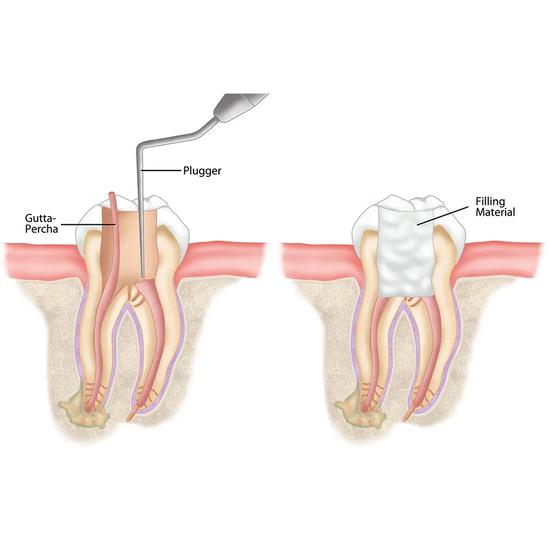 GDC Rc Plugger (Cc) -7 (.50mm) (.75mm) (Rcp5/7)