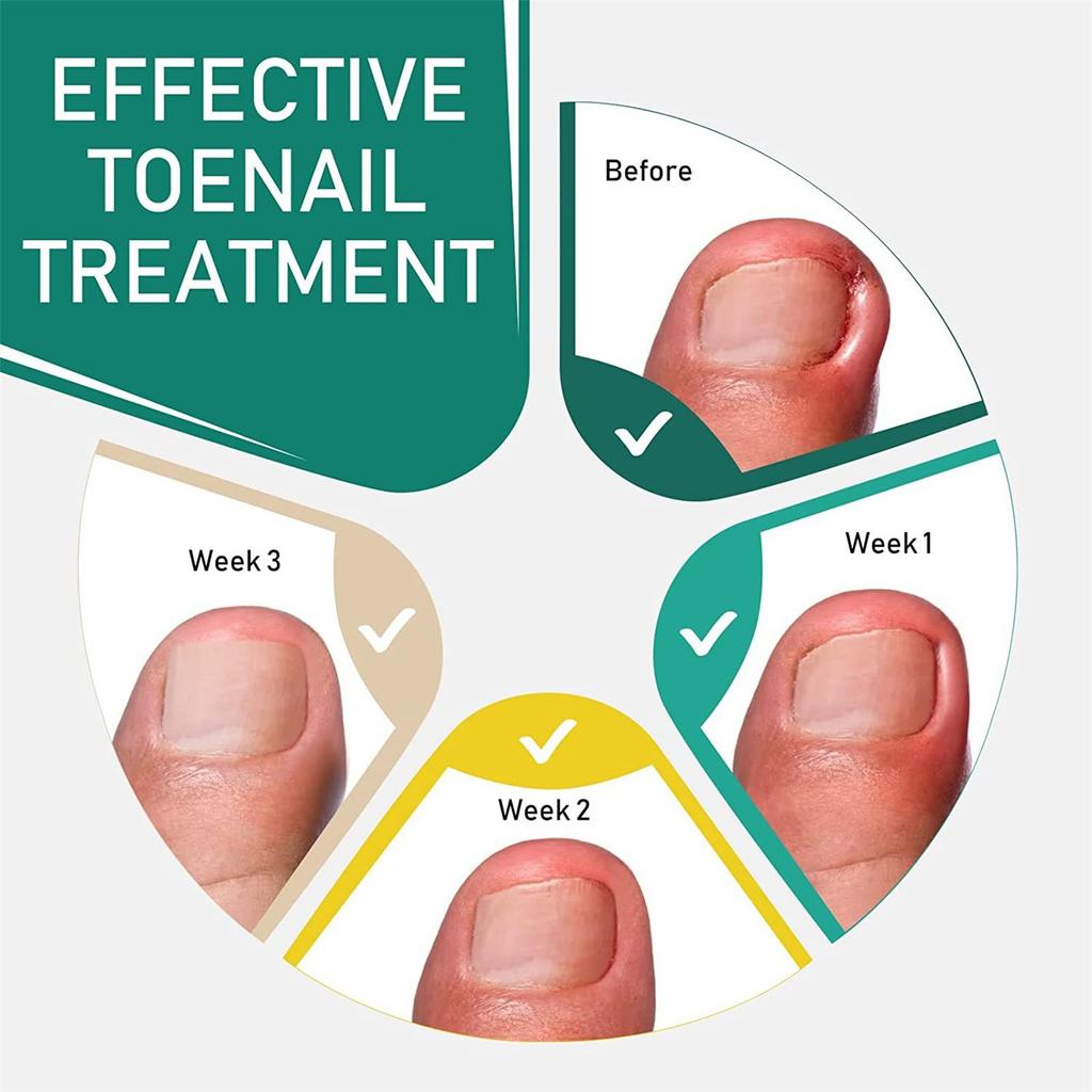 Ingrown Toenail Correction Stickers Hands And Feet Soft Nail Inlaid Nail Thickening Bright Nail Furrow Gray Nail Care Patch 50pcs