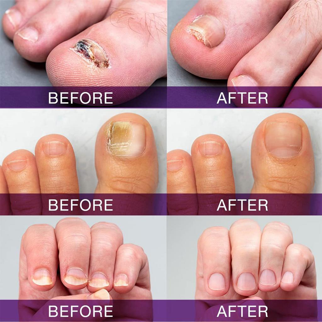 Powerful Nail Serum, Nail Care Fast & Advanced For Healthy Nails & Toenails, 20ml