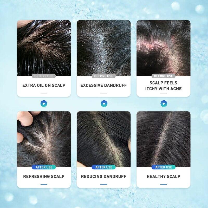 PURC Гель для кожи головы от перхоти, отшелушивающий, освежающий, против зуда, питательный продукт для ухода за волосами, 60 мл