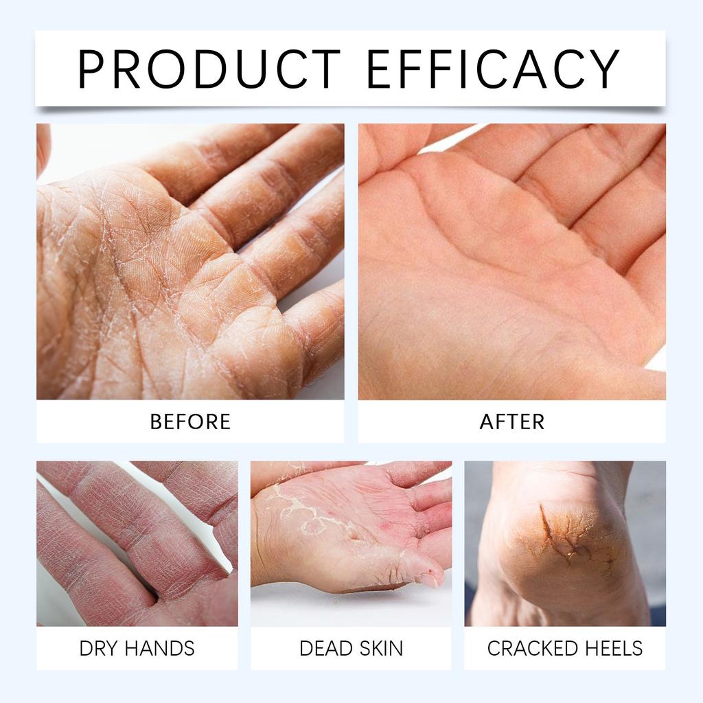 Крем с мочевиной 40 процентов Крем для рук и ног с мочевиной для сухой потрескавшейся кожи Лосьон с мочевиной 40 процентов для ног