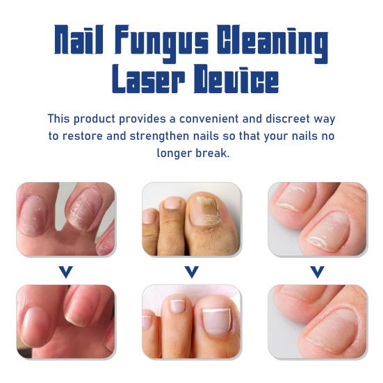Лазерное устройство для очистки ногтей от грибка ногтей Простое в эксплуатации устройство для терапии синим светом Инфракрасные холодные лазеры Устройство для ухода за ногтями