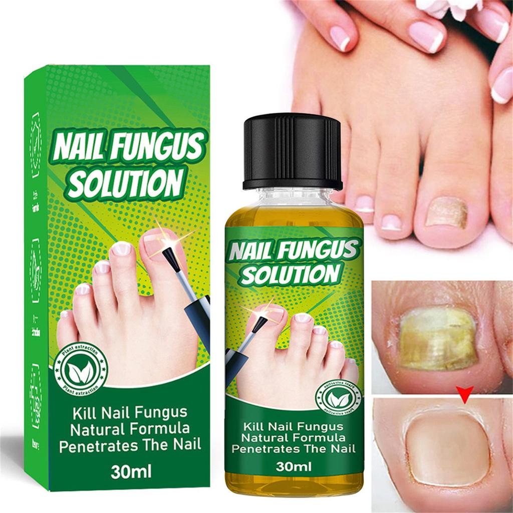 Toenail Fungus Care, FastActing Nail Care Liquid For Fungus Under & Around Restores The Healthy Appearance Of Nails 30ml