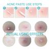 36/72/108pcs Acne Remover Sticker Anti-Acne Blackhead Treatment Plaster Acne Pimple Patch Mask Facial Care Tool Skin Care