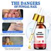 Toenail Fungal Super Strong Nail Care Nail Care Super Strong For Thick Discolored And Damaged Nails10ml