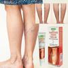 Varicose Veins Paste, Remove Varicose Veins, Varicose Veins Curing For Legs, Spider Veins Removal For Legs, Varicose Vein Renovate Paste