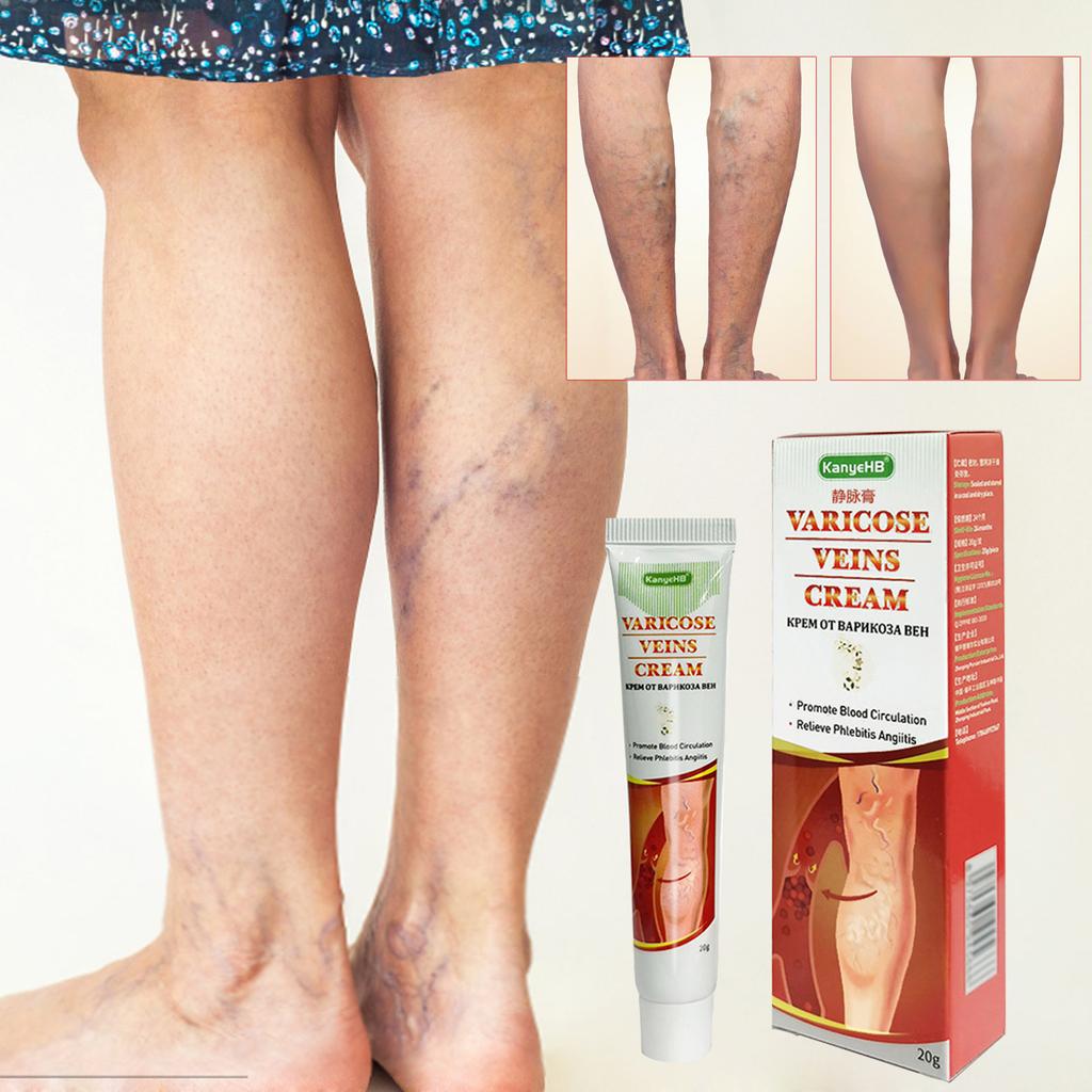 Varicose Veins Paste, Remove Varicose Veins, Varicose Veins Curing For Legs, Spider Veins Removal For Legs, Varicose Vein Renovate Paste
