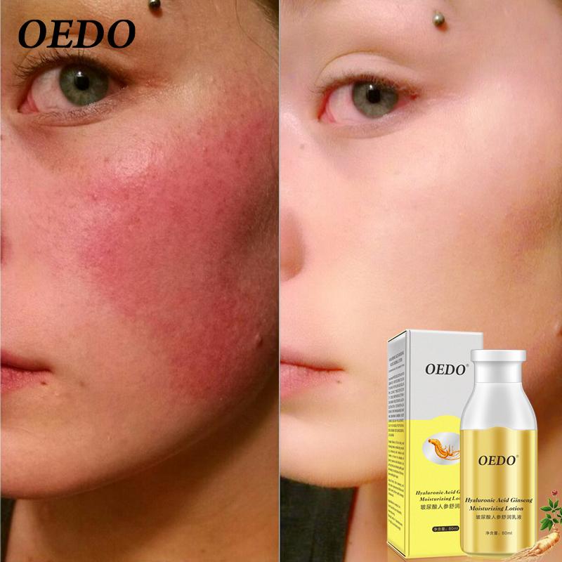 OEDO Увлажняющий лосьон с гиалуроновой кислотой и женьшенем для ухода за кожей, отбеливание, лечение акне, глубокое восстановление кожи, уход за лицом, эффект контроля жирности