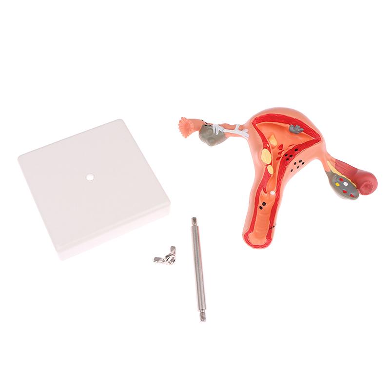 1 шт., медицинский реквизит, модель патологической матки, яичников, анатомическая модель, инструмент для изучения поперечного сечения анатомии
