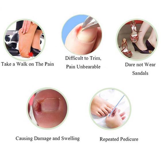 10Pcs Professional Ingrown Toenail Straightening Clip Curved Brace Toenails Correction Tool