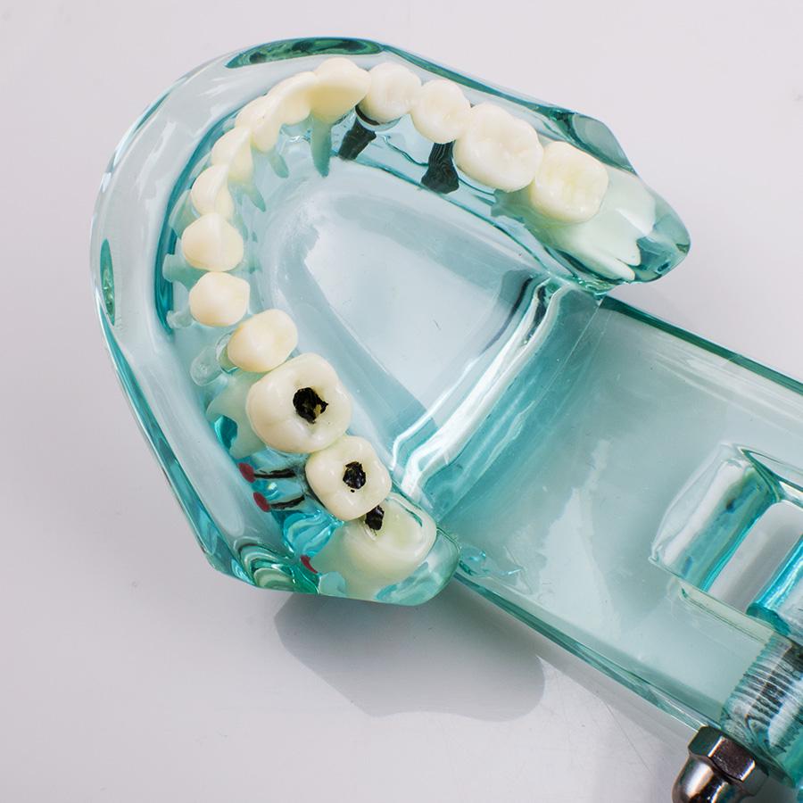 Dental Study Tooth Transparent Adult Pathological Teeth Model