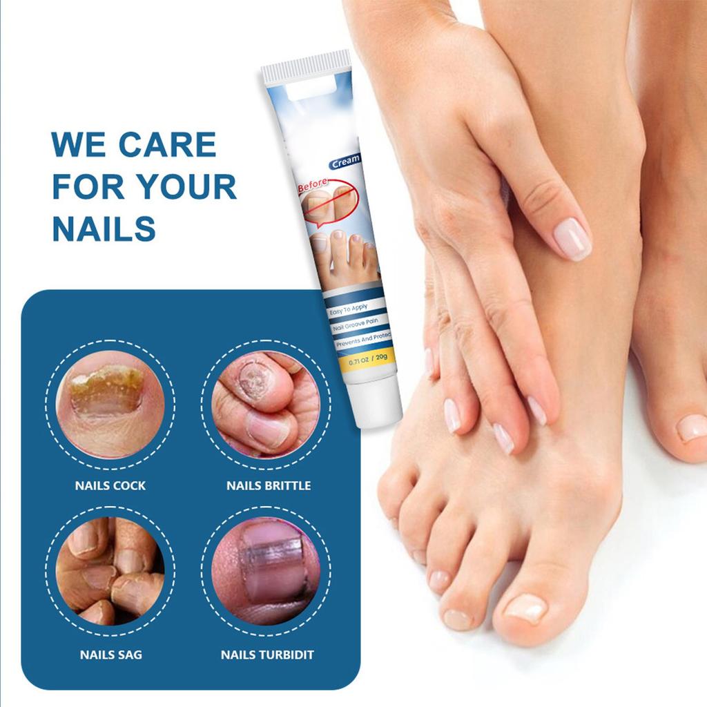 Крем для лечения ногтей, улучшает твердость ногтей, осветляет цвет ногтей