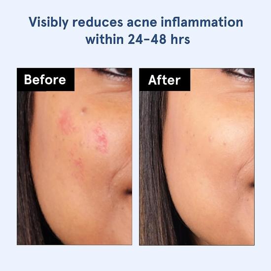 Be Bodywise Snail 96 Mucin Serum 100 мл и гидроколлоидный пластырь от прыщей (24 точки | 3 размера) | Поглощает и разглаживает прыщи за ночь, успокаивает