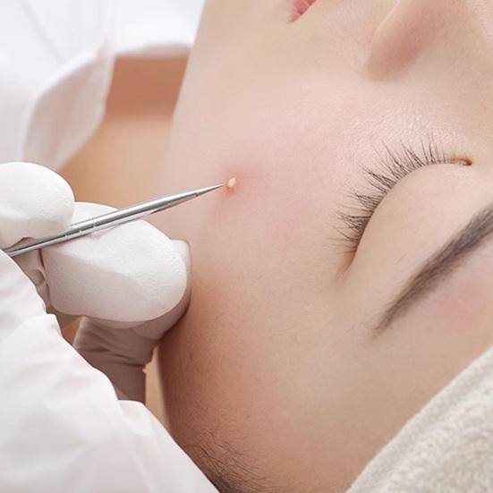 Набор из 7 инструментов для удаления черных точек из нержавеющей стали, набор игл для удаления черных точек на лице, носу, акне, для устранения пятен, набор для выдавливания белых угрей