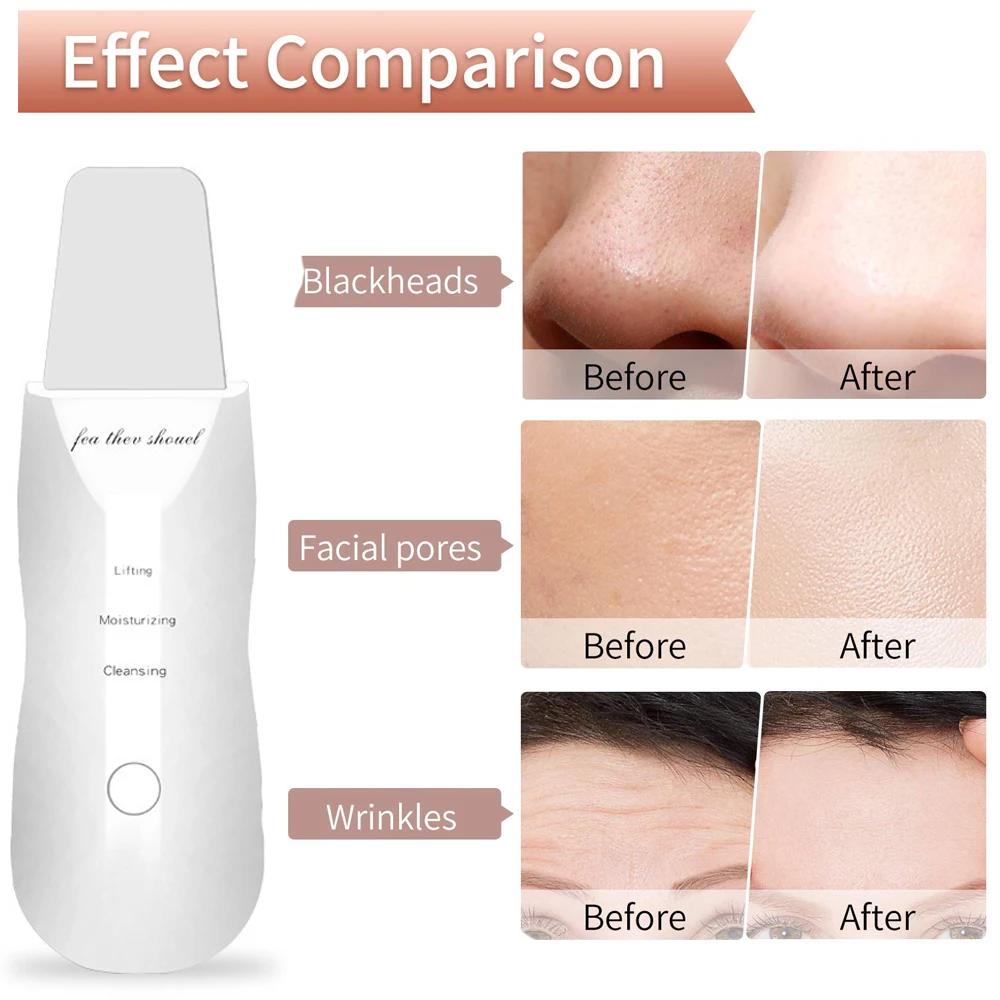 Electric Skin Scraper Ultrasonic Blackhead Remover Deep Face Cleaning Pore Facial Spatula Acne Treatment Tool