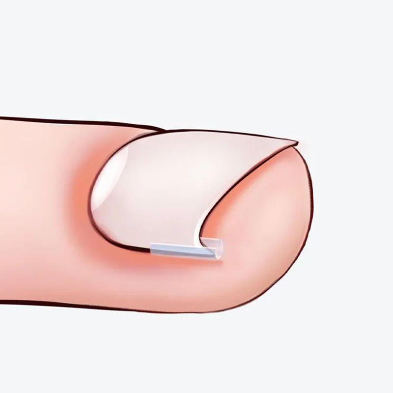 Набор из 50 шт. корректирующих подушечек для вросшего ногтя, ортез для ногтя, корректирующие полоски, бандаж для женщин и мужчин