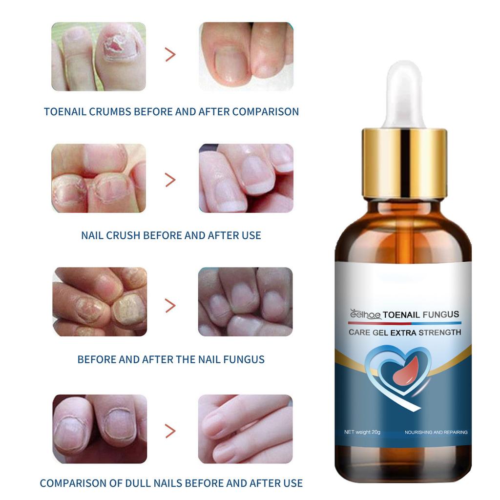Toenail Fungus Care, FastActing Nail Care Liquid For Fungus Under & Around Restores The Healthy Appearance Of Nails