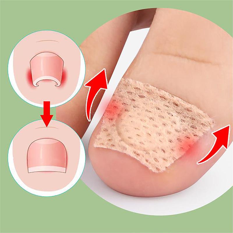 Коррекция вросшего ногтя, лечение паронихии, наклейка для ногтей на ногах, уход за ногами, педикюр, ортодонтические патчи для ногтей на большом пальце ноги