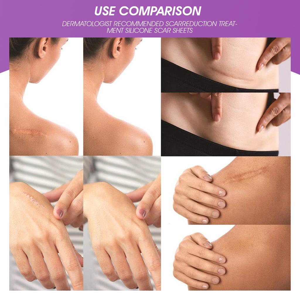 4pcs Silicone Scar Sheets Home Travel Reusable Adhesive Scar Removal Treatment Strips