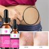 5ML/15ML/30ML/50ML/Mild Without Irritation Stretch Mark Spray Repair Removal Acne Scar Stretch Marks Cream Fat Scar Striae Gravidarum