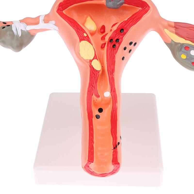 1 шт., медицинский реквизит, модель патологической матки, яичников, анатомическая модель, инструмент для изучения поперечного сечения анатомии