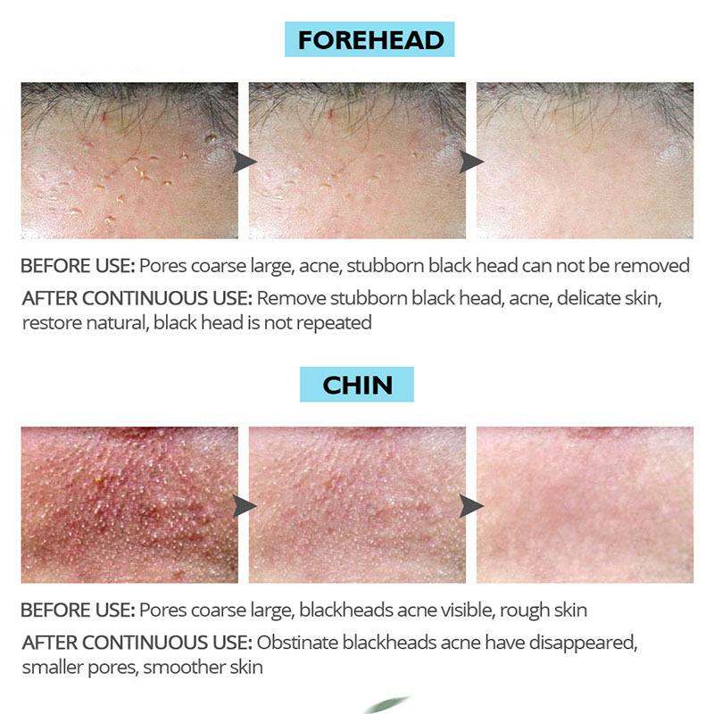 Маска для удаления черных точек – отшелушивающая маска для лица для глубокого очищения пор с бамбуковым углем, грязью и глиной