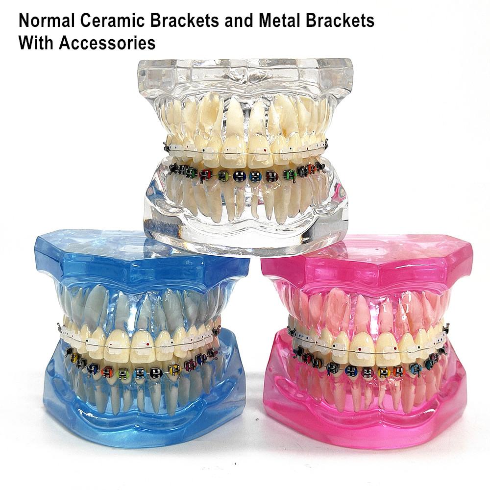 1 шт., стоматологическая ортодонтическая модель, связь с пациентом, 2 вида брекетов с дугами, лигатуры, керамический брекет, металлический краевой брекет